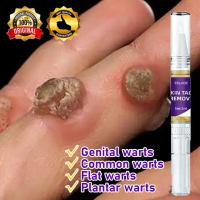 warts removal pen buang tahi lalat wart remover 100% Original
