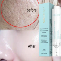 15ML AUQUEST Salicylic Acid Acne Treatment Face Cream Anti-acne Gel Shrink Pores Moisturizing Serum Remove Blackheads Skin Care