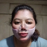 Pemancung hidung dan Filler Wajah