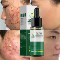 Tea Tree Acne Removal Face Serum Effective Anti-Acne Spots Scar Repair Treatment Moisturizing Whitening Oil Control Skin Care