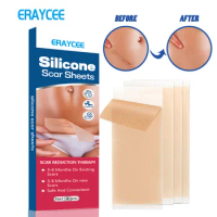 ERAYCEE Silicone Scar Patch Self-adhesive Silicone Patch For Surgical Acar Incision Scar Patch for Burn Cosmetic Patch