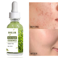 High Quality Herbal Acne Essence Anti-Acne Repair Fades Acne Print Oil Control Cream Whitening Moisturizing Skin Care