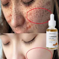 Whitening Freckle Serum Brighten Remove Dark Spot Fade Pigment Melanin Correcting Face Essence Turmeric Retinol Anti Aging Care