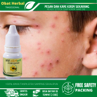 Penghilang Bekas Cacar Di Wajah, Salep Cacar Air, Penghilang Bekas Cacar di Seluruh Badan Dengan Pro