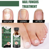 Sdotter New 30ml/50ml Toenail Fungus Treatment Extra Strength Care Nail Repair Solution Feet Care Essence for Finger Toenail