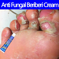 ubat kulat air kaki gatal kulit antibacterial foot fungusointment cream kaki berbau busuk Inhibit fo