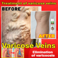 Varicose Veins Cream Removal Varicose Veins Best Against Varicose Veins Products Natural Plant Extracts For Varicose Veins