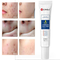 Anti Acne Face Cream Salicylic Acid Acne Removing Cream Waterproof Balancing Cream for Acne Scars and Pits Reduce Blemishes