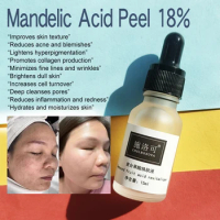 Almond acid Benefits for Skin Discoloration Hyperpigmentation Melasma Age Spots Sun Damage Mandelic Acid Peel self-esteem