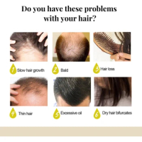Shampoo Soap with Rice Water Aloe Vera Extract Anti-hair Loss Shampoo Bar for Hair Loss Nourish Dry Damaged Hair Repair