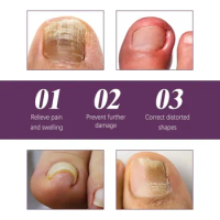 Sdottor New Toenail Correction Sticker Anti Infection Fungal Paronychia Treatment Foot Thumb Ingrown removal Onychomycosis Nail