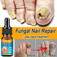 Jemeesen Fungal Nail Repair Liquid Anti Infection Paronychia Essence Removal Onychomycosis Serum Foot Nails Treatment Essence