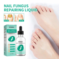 Nail Fungal Essentie Treatment Feet Essence Anti Infection Paronychia Onychomycosis Foot Nail Fungus Removal Essential Oils