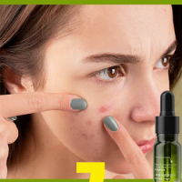 Acne Treatment Face Cream Salicylic Acid Acne Scar Pimple Remover Whitening Oil Control Smoothing Facial Skin Care