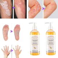 jerawat Acne body wash ubat mandian badan acne mites removing goose bumps Acid Eczema Itchy Skin Ant