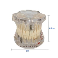 Sale Model studi gigi implant crown bridge bening transparan phantom dentalSale
