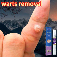 warts removal pen buang tahi lalat wart remover 100% Original