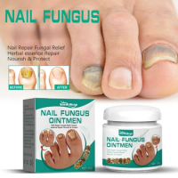 Nail Fungus Removal Cream Onychomycosis Fungal Nail Treatment Paronychia Anti Infection Feet Toe Fungal Nail Care Ointment