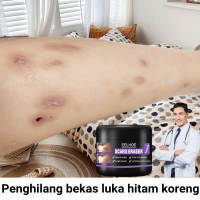 Krim hilangkan parut hitam Scar removal cream Penghilang bekas luka Ubat parut kaki Chicken pox scar