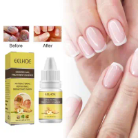 Nail Fungus Removal Cream Onychomycosis Fungal Nail Toe Infection Care Feet Fungal Ointment Treatment Anti Nail Paronychia A1Y9