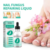 Sdotter New Fungal Nail Gel Treatment quickly Feet Care Essence Anti Infection Ingrown toenail Repair Foot Toe for Nails oil Fun