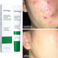 Salicylic Acid Acne Removal Cream Effective Acne Treatment Remove Blackheads Acne Oil Control Shrink Pore Moisturizing Skin Care