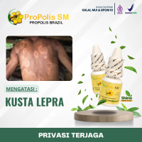 Salep Kusta Lepra Penghilang Bercak Putih di Kulit Lesi Kulit Panu Bercak Dengan Propolis Sm Isi 6ml