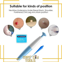Alat Penghilang Kutil Painless Skin Tag Mole Removal Kit [Biru]