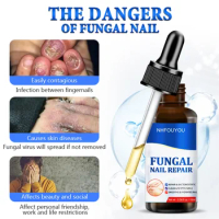 Fungal Nail Treatment Oil Foot Repair Essence Toe Nail Fungus Removal Gel Anti Infection Cream Fungal Nail Removal 10ML